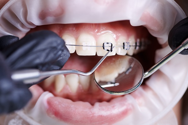 Braces Specialist: Your Path To Straighter Teeth